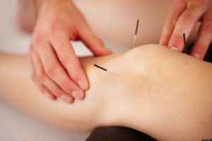 Medicinsk akupunktur